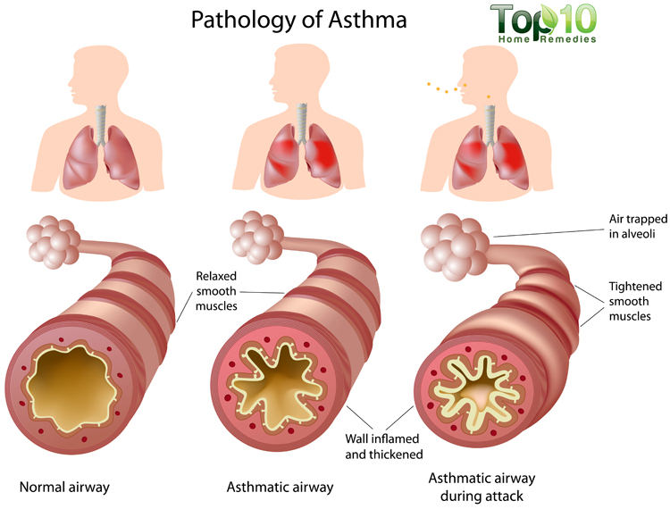 asthma-big